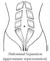 Diastasis Recti Repair